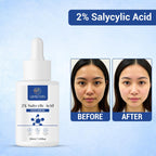 GLOWVEDDA SALICINAMIDE SKIN RESET ANTI ACNE SERUM